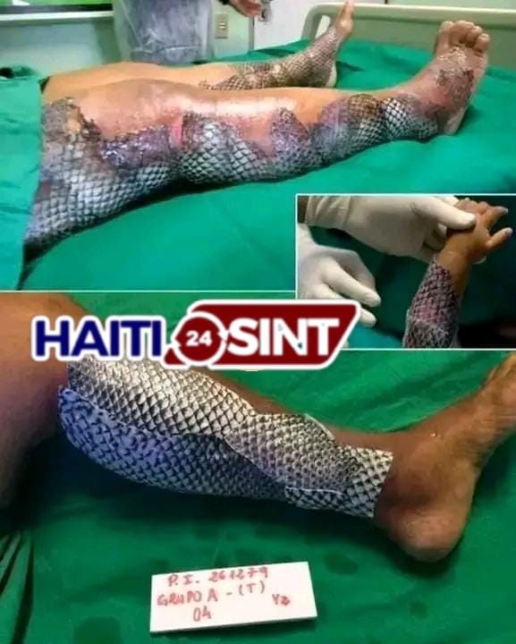 Comment des médecins soignent les brûlures avec de la peau de poisson… et les résultats étonnent